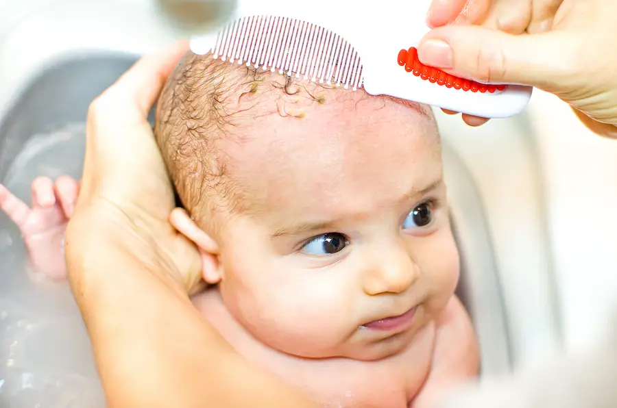 Treating baby cradle cap
